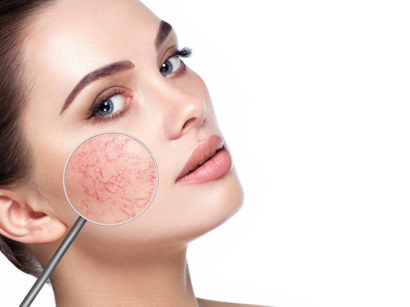 cuperose and rosacea